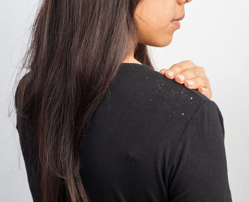 Girl with dandruff solid shampoo bar